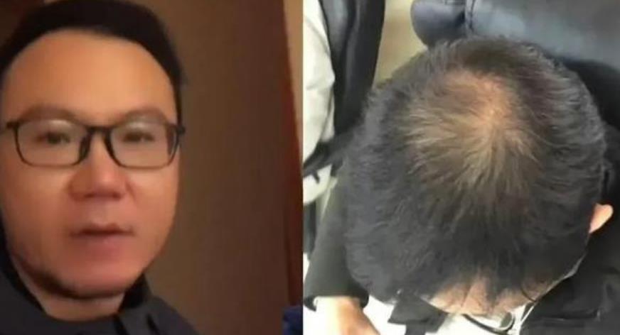 男子半年不用洗发水 秃顶变满头黑发 男子半年不用洗发水 秃顶变满头黑发