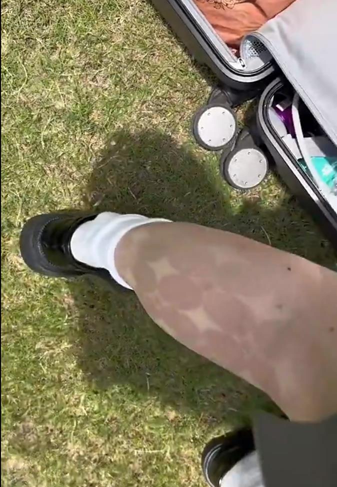 女生穿白色丝袜拍照两小时,喜提“半永久纹身”:烈日太毒太晒